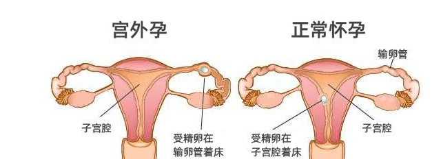 宫外孕大出血危在旦夕区三医院医护团队快速救治转危